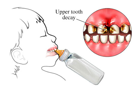 infant tooth decay